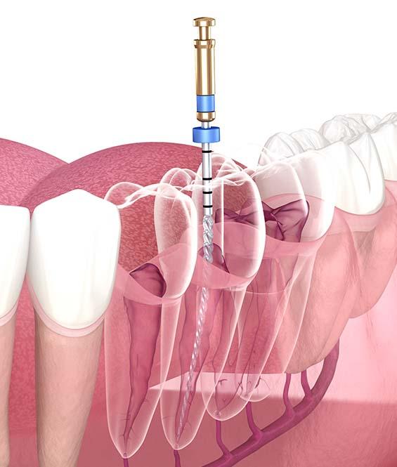 endodontics